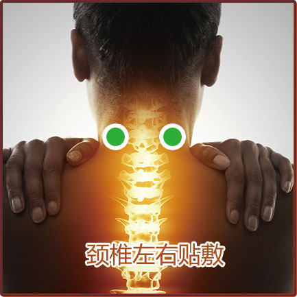动脉型颈椎病贴敷位置示意图